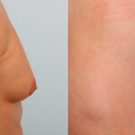 Gynecomastia (Male Breast Reduction) before and after photos in Houston, TX, Patient 28674