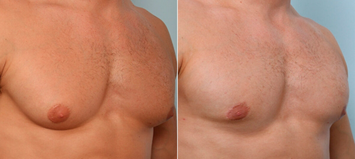 Gynecomastia (Male Breast Reduction) before and after photos in Houston, TX, Patient 28674