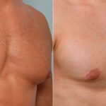 Gynecomastia (Male Breast Reduction) before and after photos in Houston, TX, Patient 28674