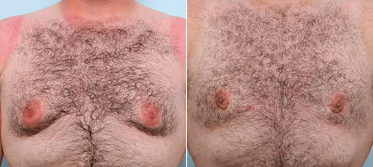 Gynecomastia (Male Breast Reduction) before and after photos in Houston, TX, Patient 28681