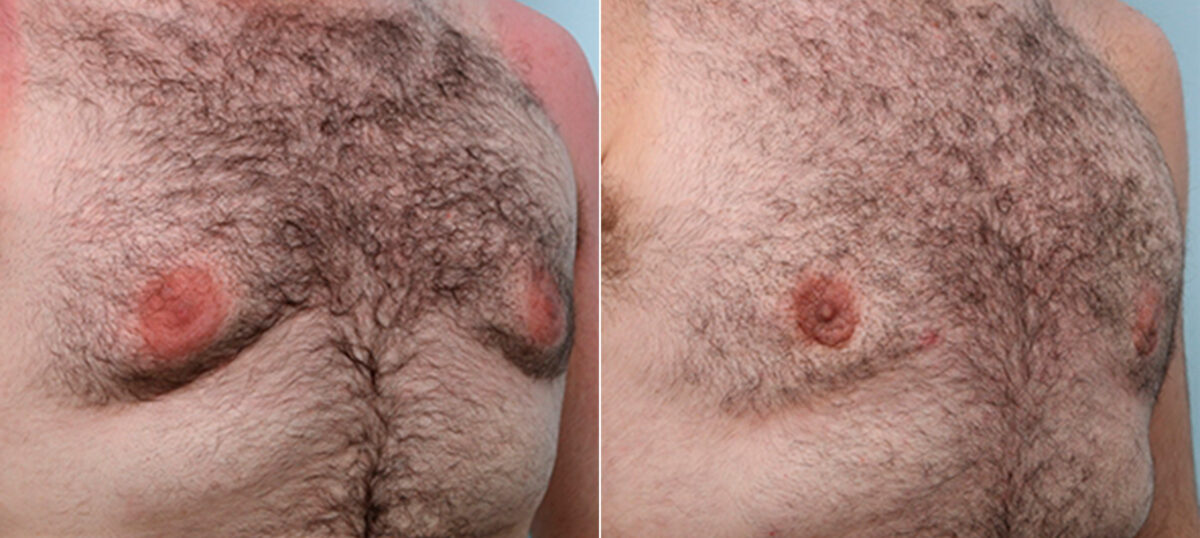 Gynecomastia (Male Breast Reduction) before and after photos in Houston, TX, Patient 28681