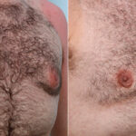 Gynecomastia (Male Breast Reduction) before and after photos in Houston, TX, Patient 28681