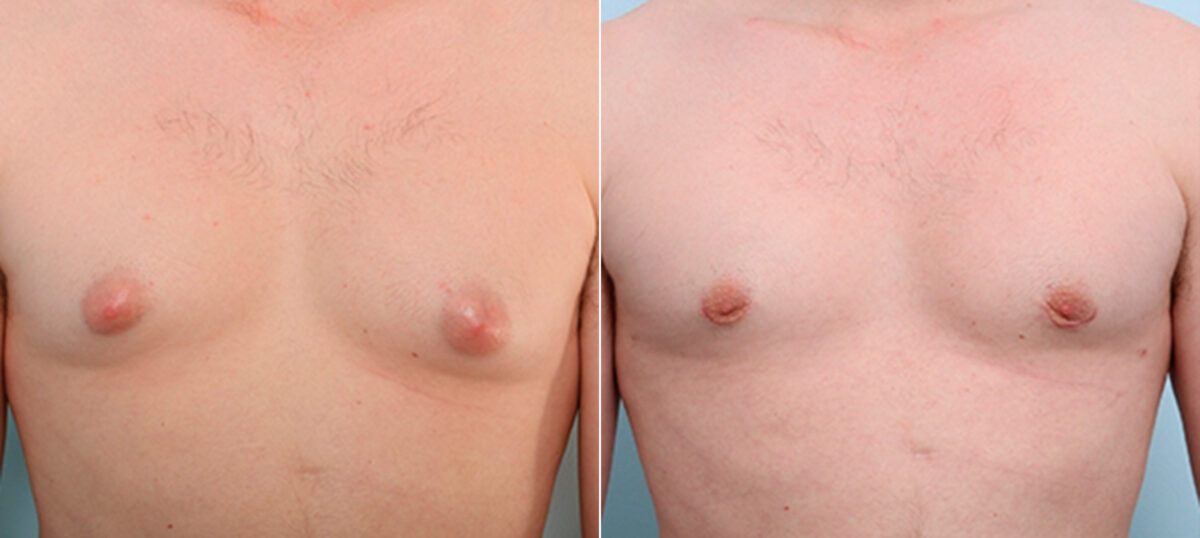 Gynecomastia (Male Breast Reduction) before and after photos in Houston, TX, Patient 28688