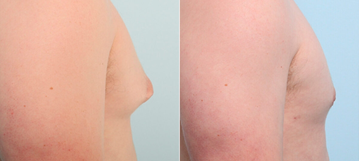 Gynecomastia (Male Breast Reduction) before and after photos in Houston, TX, Patient 28688