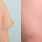 Gynecomastia (Male Breast Reduction) before and after photos in Houston, TX, Patient 28688