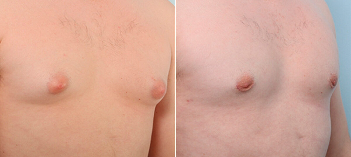 Gynecomastia (Male Breast Reduction) before and after photos in Houston, TX, Patient 28688