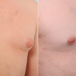 Gynecomastia (Male Breast Reduction) before and after photos in Houston, TX, Patient 28688