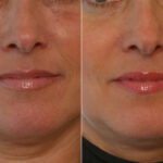 Juvederm Injectable Gel before and after photos in Houston, TX, Patient 28710