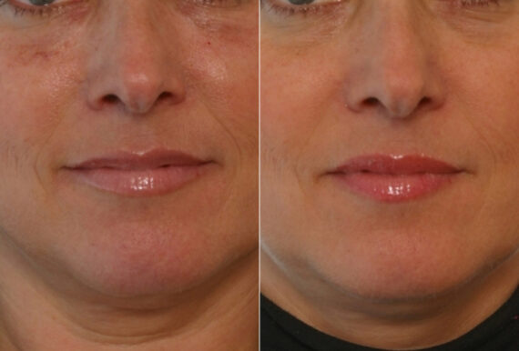 Juvederm Injectable Gel before and after photos in Houston, TX, Patient 28710