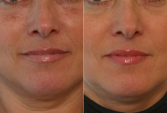 Juvederm Injectable Gel before and after photos in Houston, TX