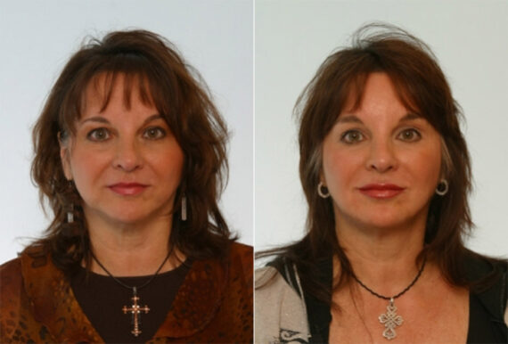 Juvederm Injectable Gel before and after photos in Houston, TX, Patient 28713