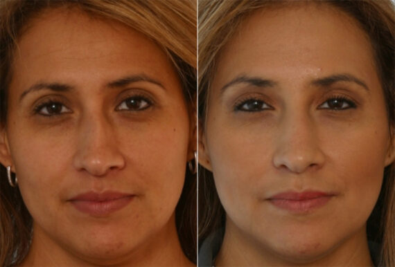 Juvederm Injectable Gel before and after photos in Houston, TX, Patient 28716