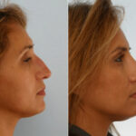 Juvederm Injectable Gel before and after photos in Houston, TX, Patient 28716