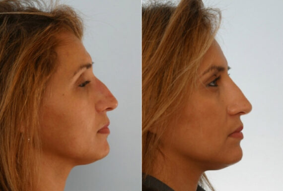 Juvederm Injectable Gel before and after photos in Houston, TX, Patient 28716