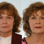 Juvederm Injectable Gel before and after photos in Houston, TX, Patient 28721