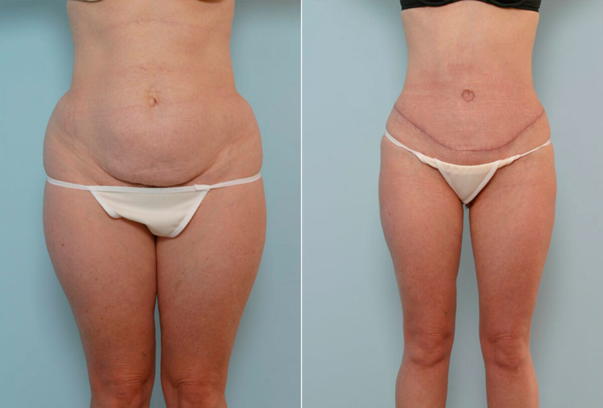 Abdominoplasty before and after photos in Houston, TX, Patient 24655