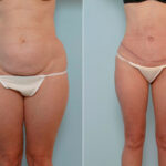 Abdominoplasty before and after photos in Houston, TX, Patient 24655