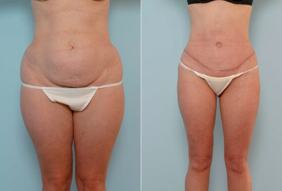 Abdominoplasty before and after photos in Houston, TX, Patient 24655