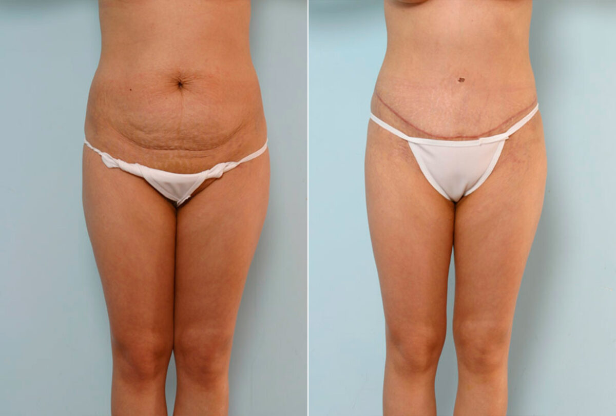 Tummy Tuck/Abdominoplasty before and after photos in Houston, TX, Patient 24243