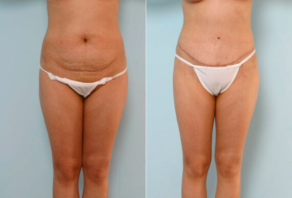 Tummy Tuck/Abdominoplasty before and after photos in Houston, TX, Patient 24243
