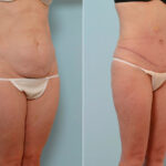 Abdominoplasty before and after photos in Houston, TX, Patient 24655