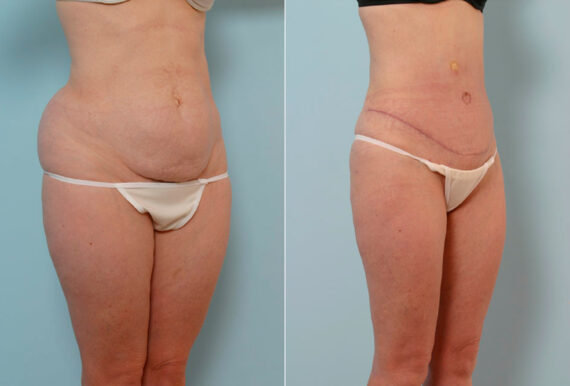 Abdominoplasty before and after photos in Houston, TX, Patient 24655