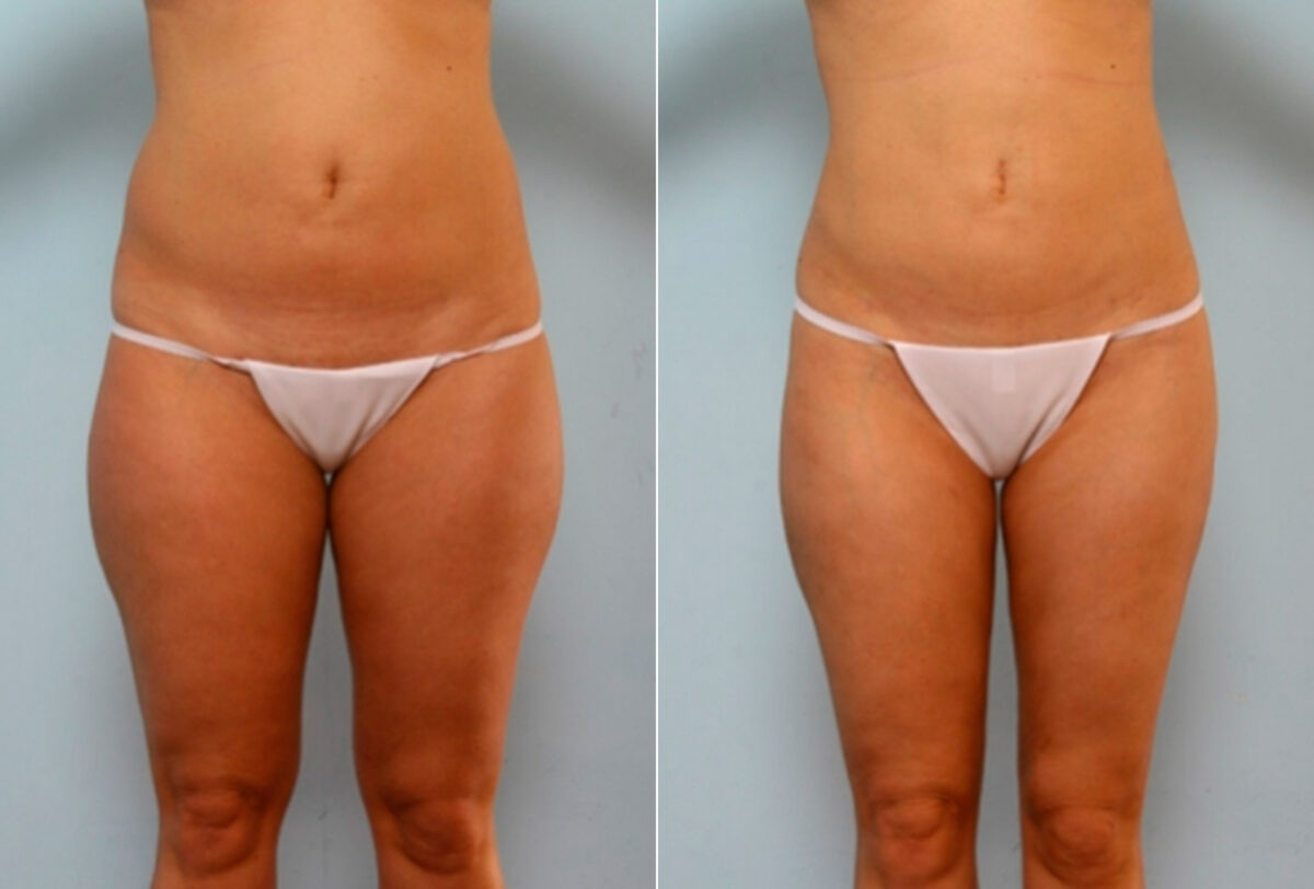 Liposuction before and after photos in Houston, TX, Patient 28860