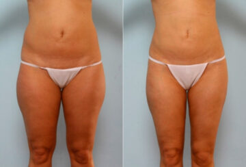 Liposuction before and after photos in Houston, TX, Patient 28860