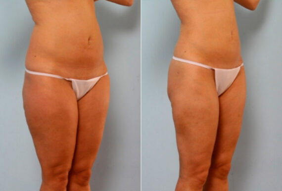 Liposuction before and after photos in Houston, TX, Patient 28860