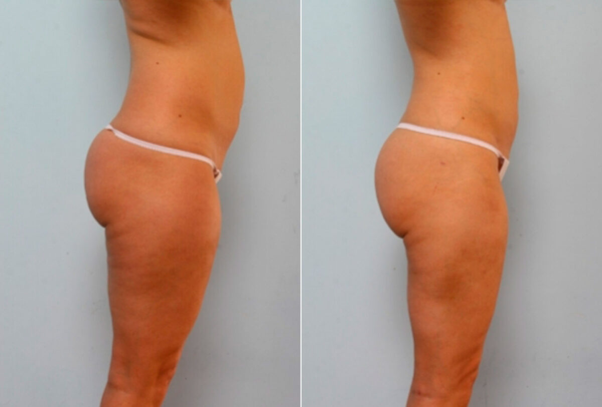 Liposuction before and after photos in Houston, TX, Patient 28860