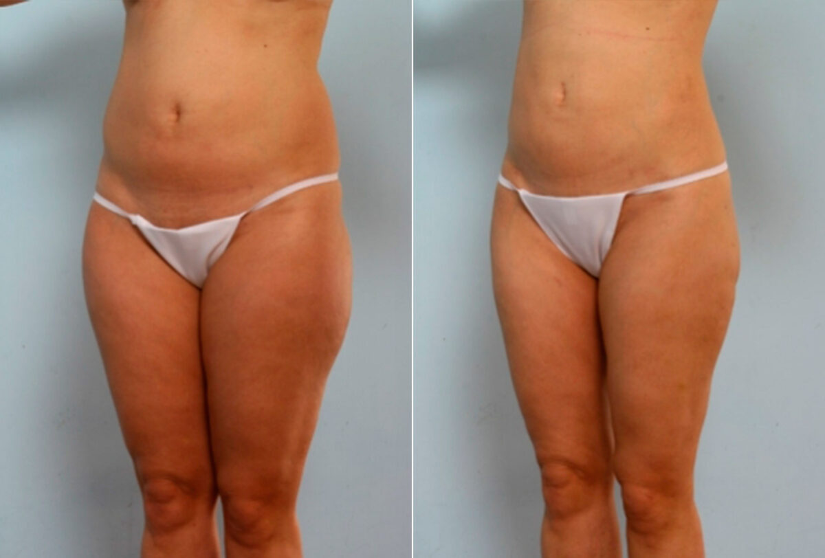 Liposuction before and after photos in Houston, TX, Patient 28860