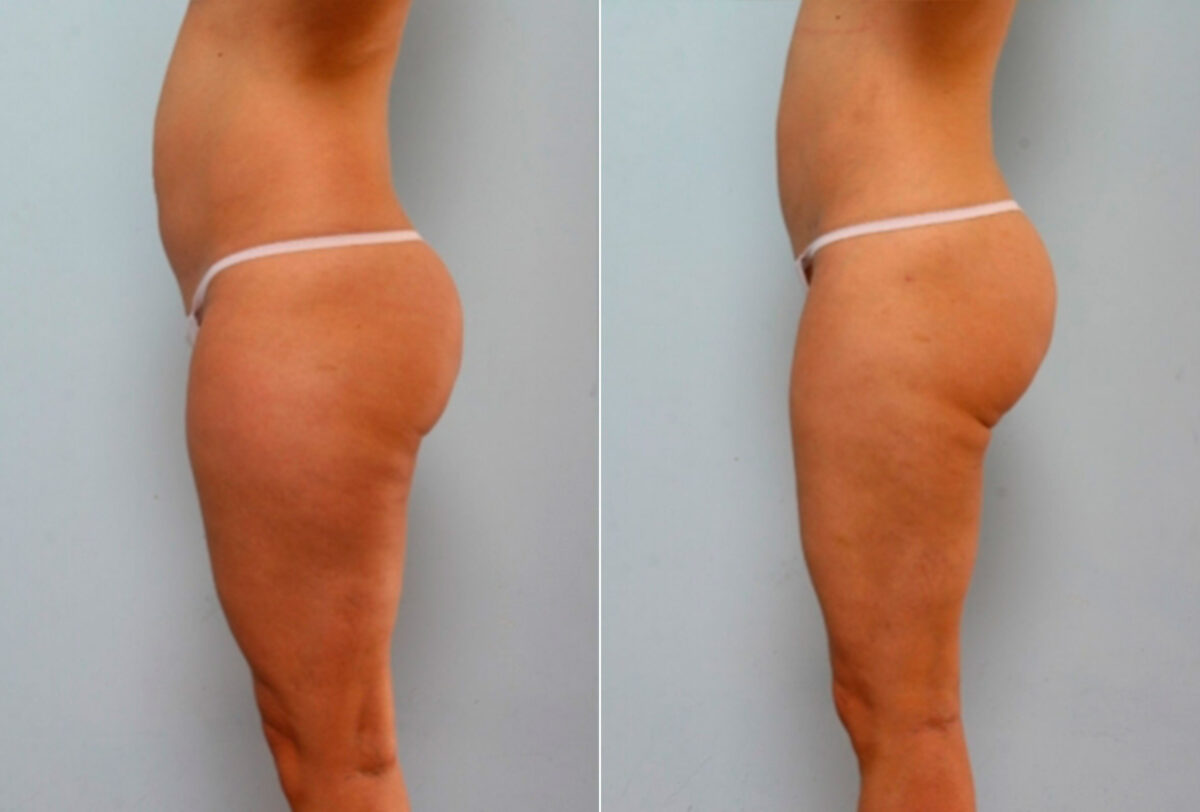 Liposuction before and after photos in Houston, TX, Patient 28860