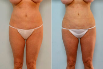Liposuction before and after photos in Houston, TX, Patient 28871