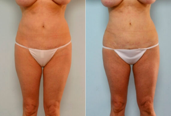 Liposuction before and after photos in Houston, TX