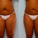 Liposuction before and after photos in Houston, TX, Patient 28874