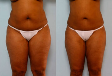 Liposuction before and after photos in Houston, TX, Patient 28874