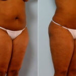 Liposuction before and after photos in Houston, TX, Patient 28874