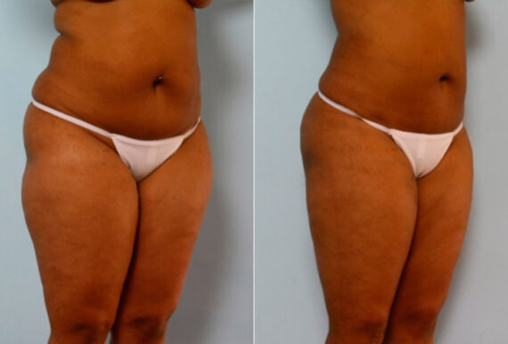 Liposuction before and after photos in Houston, TX, Patient 28874