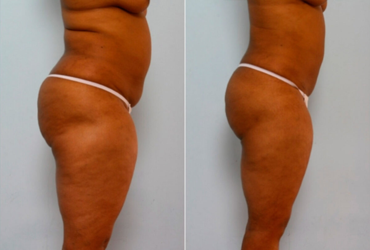 Liposuction before and after photos in Houston, TX, Patient 28874