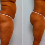 Liposuction before and after photos in Houston, TX, Patient 28874