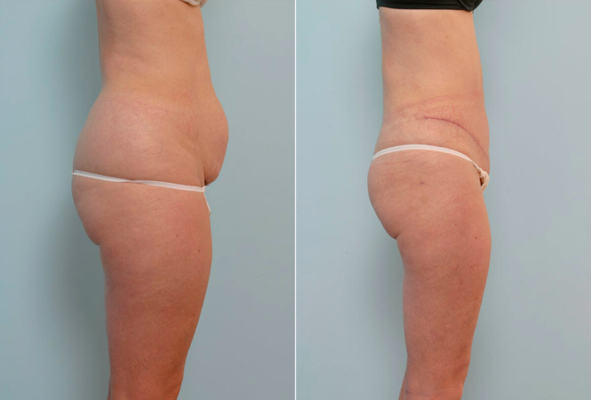 Abdominoplasty before and after photos in Houston, TX, Patient 24655