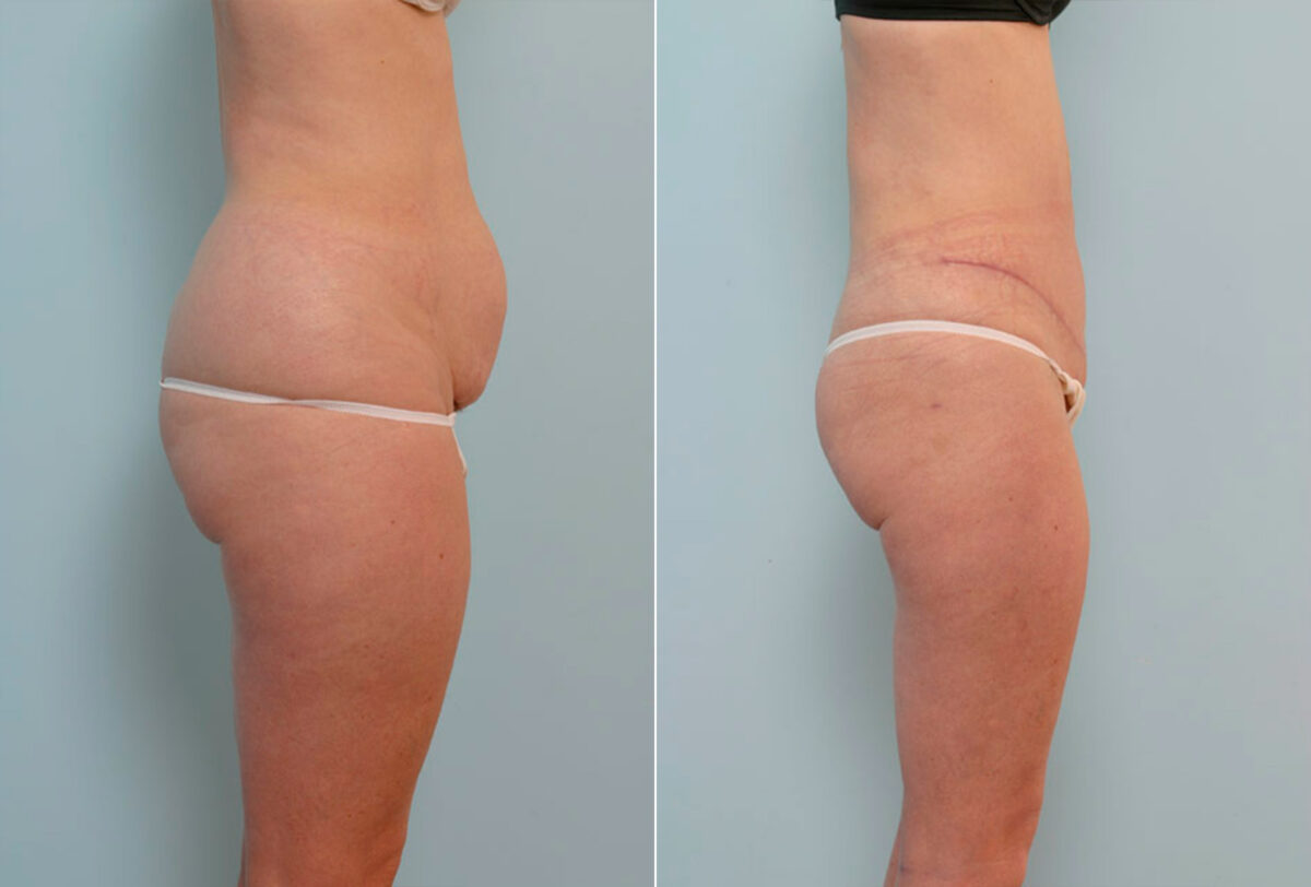 Tummy Tuck/Abdominoplasty before and after photos in Houston, TX, Patient 24655