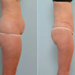 Abdominoplasty before and after photos in Houston, TX, Patient 24655