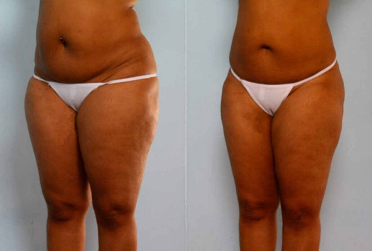 Liposuction before and after photos in Houston, TX, Patient 28874