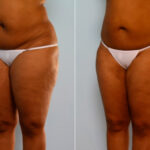 Liposuction before and after photos in Houston, TX, Patient 28874