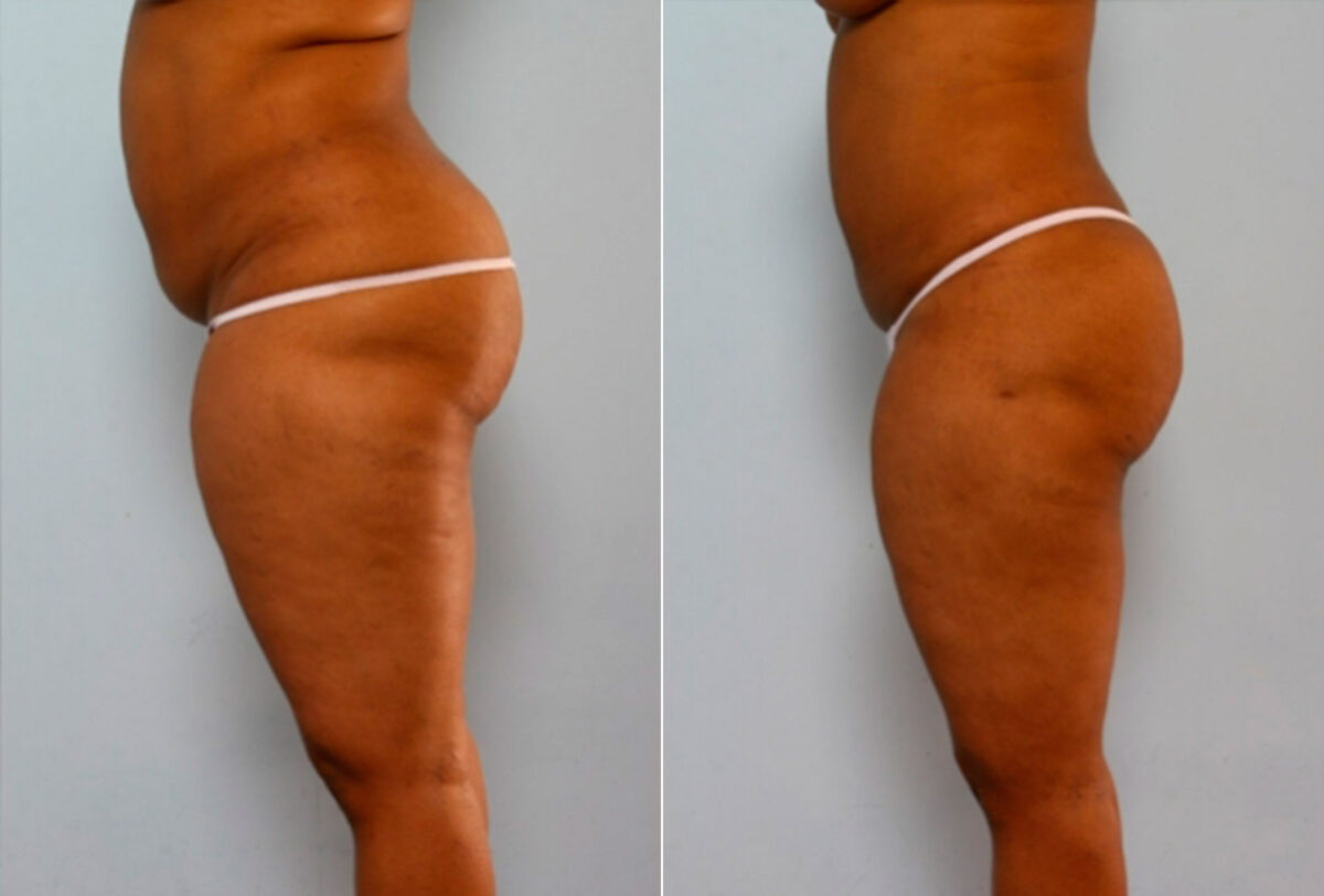 Liposuction before and after photos in Houston, TX, Patient 28874