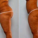 Liposuction before and after photos in Houston, TX, Patient 28874