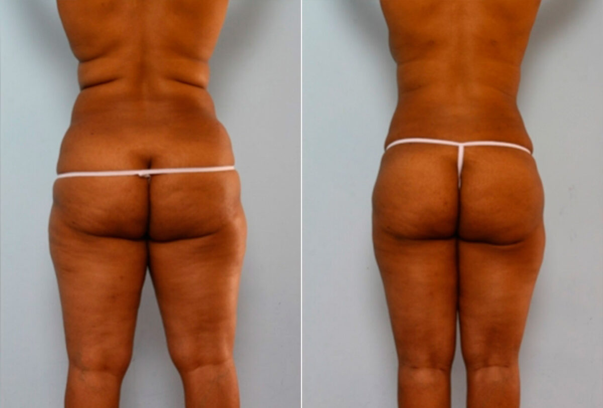 Liposuction before and after photos in Houston, TX, Patient 28874