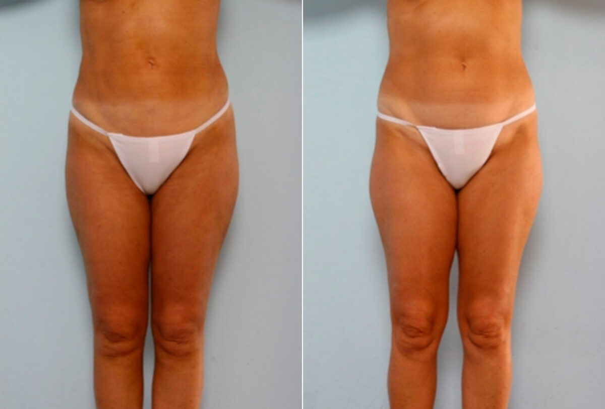 Liposuction before and after photos in Houston, TX, Patient 28887