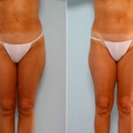 Liposuction before and after photos in Houston, TX, Patient 28887